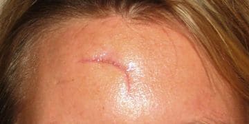 Scar Revisions in Austin from Facial Focus Cosmetic Surgery