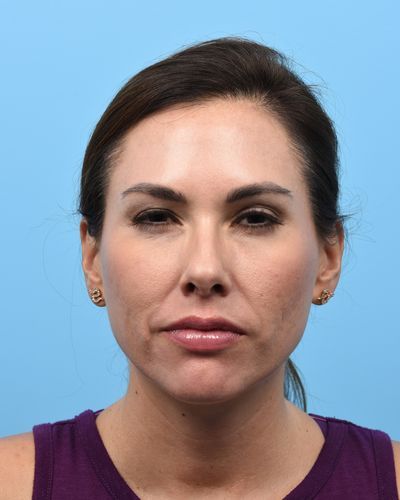 2 weeks post treatment with smooth glabella on attempted "frown" facial expression