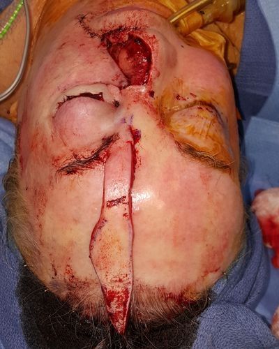 Intraoperative view following left cheek advancement flap, left lip advancement flap, skin graft, and just prior to forehead flap inset
