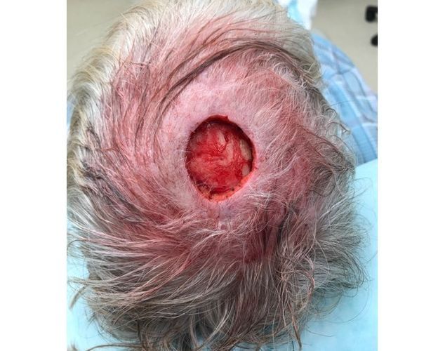 Large acquired scalp defect following Moh's Surgery