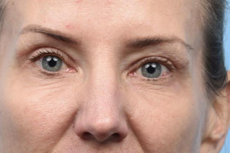 2.5 months post Upper Blepharoplasty with TCA Peel