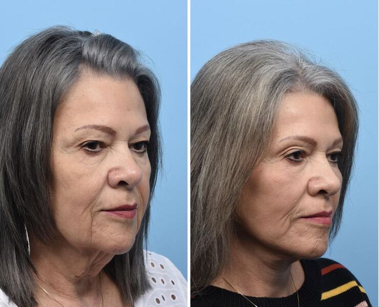 Face and Neck Lift
