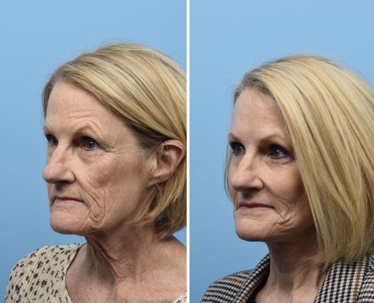 Upper/Lower Blepharoplasty with Brow Lift