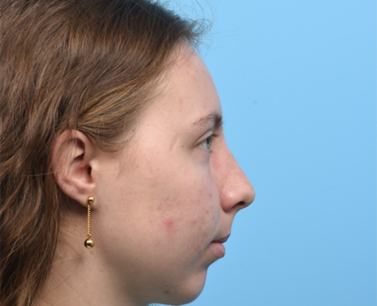 1 month post rhinoplasty and chin implant
