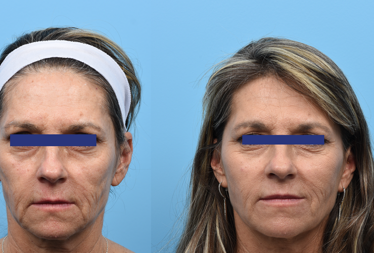 6 Syringe (5.5ml) Volume Enhancement of Cheeks, Nasolabial Folds, Lower Face, + Lip Augmentation. Six weeks post SkinPen Facial Microneedling x 1.