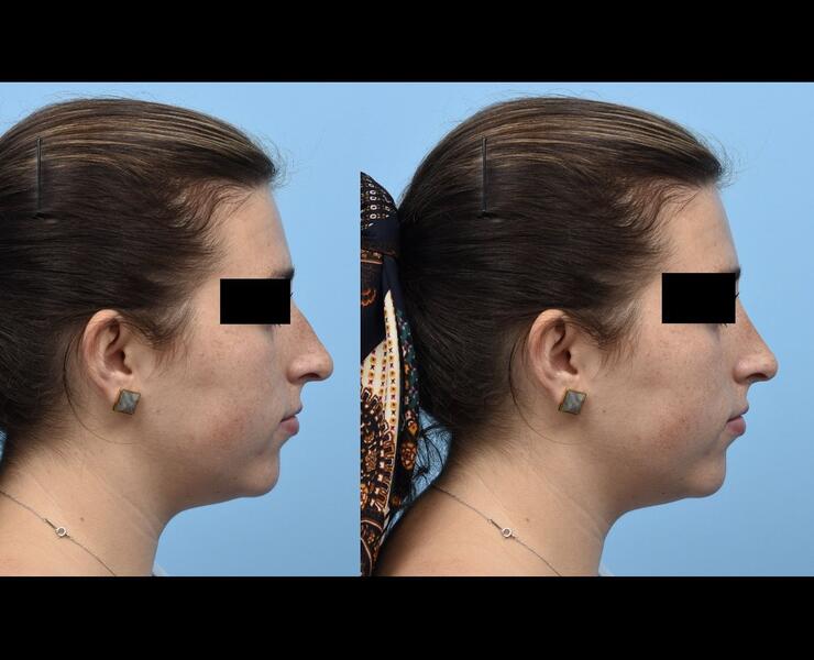 Pre Septorhinoplasty (L) with morphed image (R)