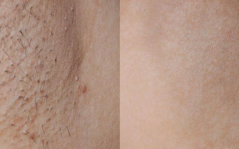 Laser Hair Removal