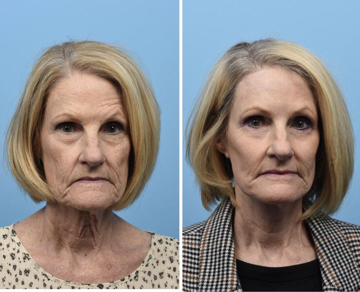 Upper/Lower Blepharoplasty with Brow Lift