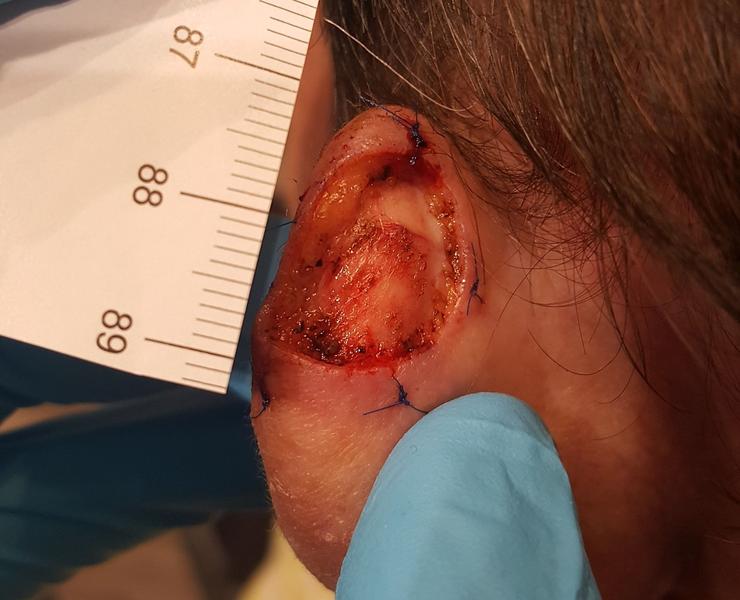 Ear reconstruction intraop