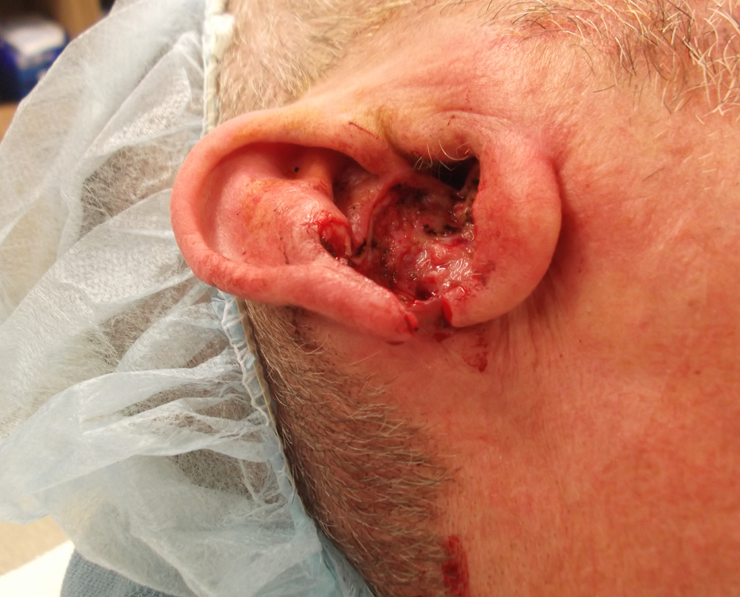 Complex Full Thickness Ear Defect