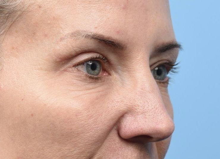 2.5 months post Upper Blepharoplasty with TCA Peel