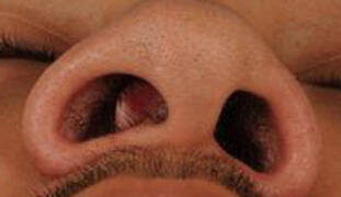 Anatomic nasal obstruction symptoms