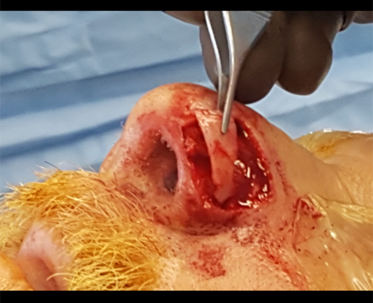 Septal cartilage graft for nasal alar support