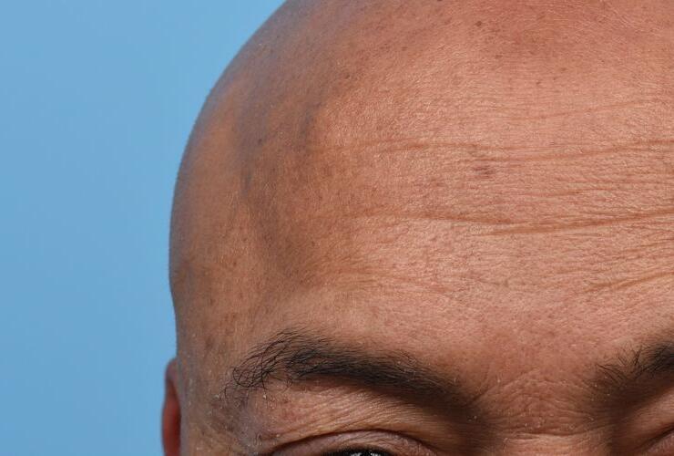 Close up of forehead lesion (lipoma)