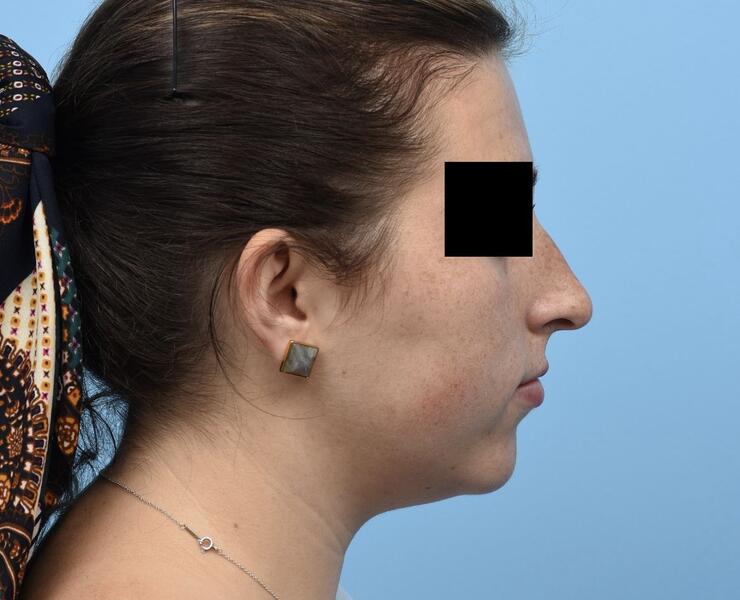 Pre Septorhinoplasty Lateral View