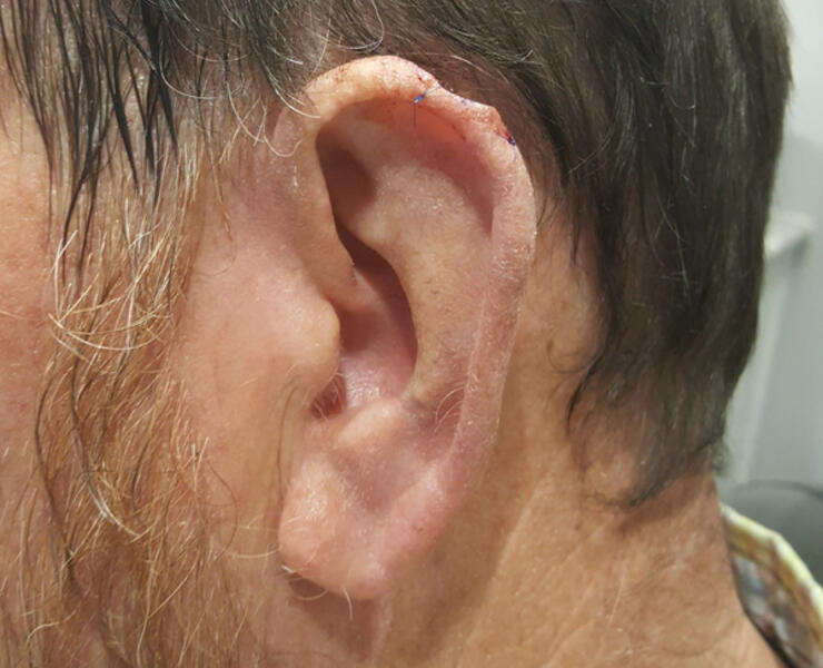 Pre ear skin cancer reconstruction