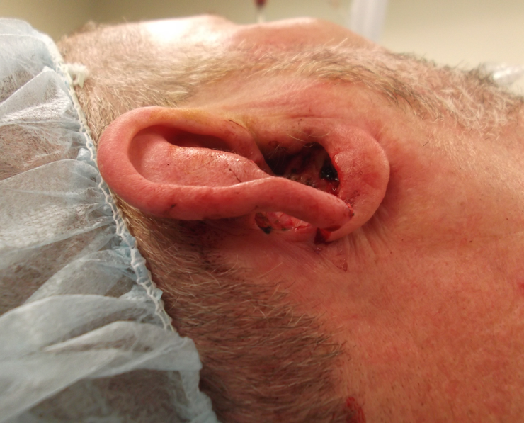 Complex Full Thickness Ear Defect