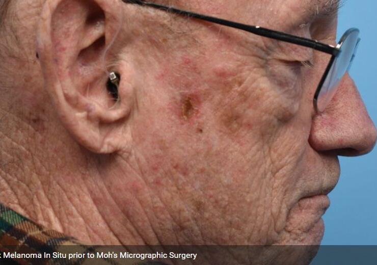 Right Cheek Melanoma In Situ prior to Moh's Micrographic Surgery