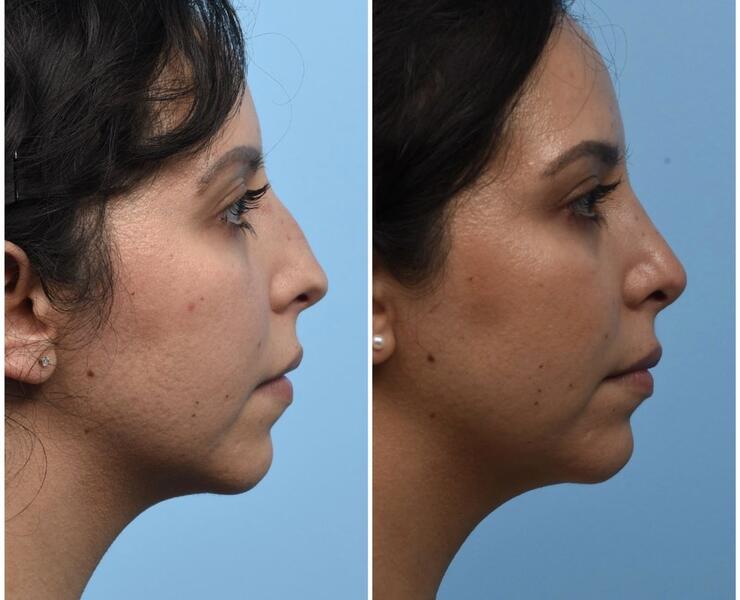 Before/After Lateral View