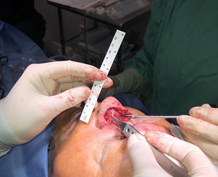 Intraop Dorsal Nasal Flap with Ear Cartilage Graft